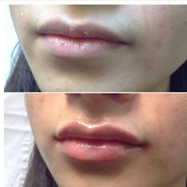 PLUMMING EFFECT ON LIPS 